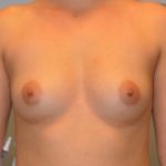 Breast Augmentation Before & After Patient #2959