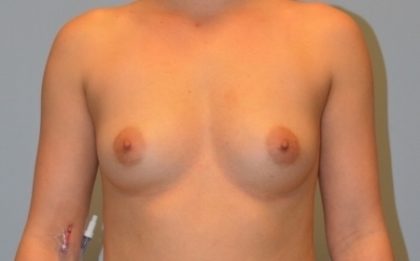Breast Augmentation Before & After Patient #2959