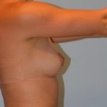 Breast Augmentation Before & After Patient #2959