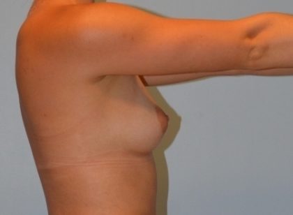 Breast Augmentation Before & After Patient #2959