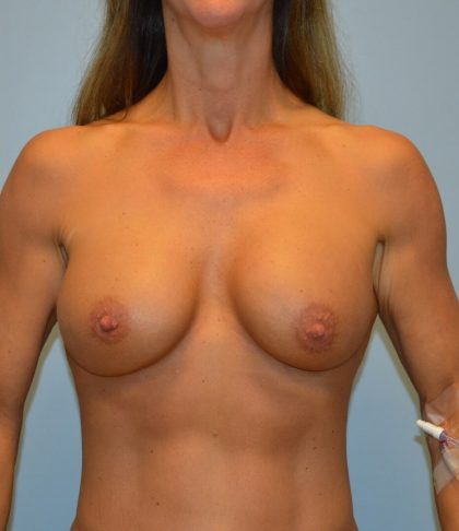 Breast Augmentation Before & After Patient #2813