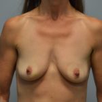 Breast Augmentation Before & After Patient #2813