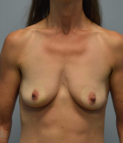 Breast Augmentation Before & After Patient #2813