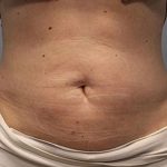 Fat Reduction (Non-Invasive) Before & After Patient #3016