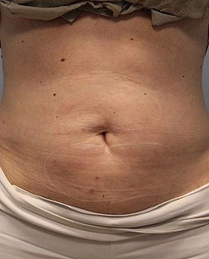 Fat Reduction (Non-Invasive) Before & After Patient #3016