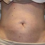 Fat Reduction (Non-Invasive) Before & After Patient #3016