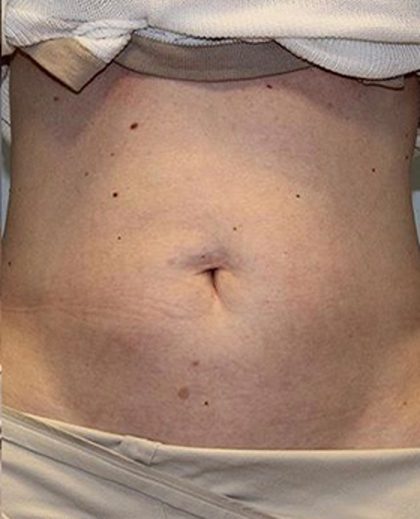 Fat Reduction (Non-Invasive) Before & After Patient #3016