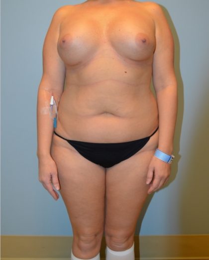 Liposuction Before & After Patient #2960