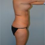 Liposuction Before & After Patient #2960
