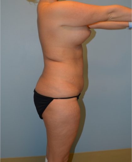 Liposuction Before & After Patient #2960