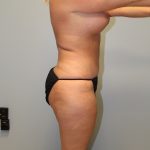 Liposuction Before & After Patient #2960