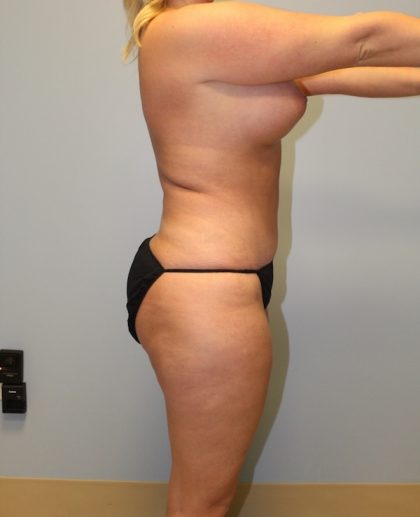 Liposuction Before & After Patient #2960