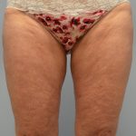 Fat Reduction (Non-Invasive) Before & After Patient #2939