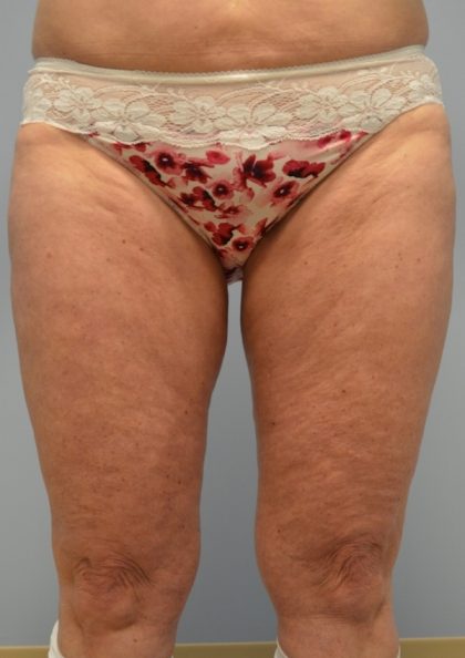 Fat Reduction (Non-Invasive) Before & After Patient #2939