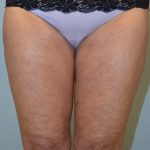 Fat Reduction (Non-Invasive) Before & After Patient #2939