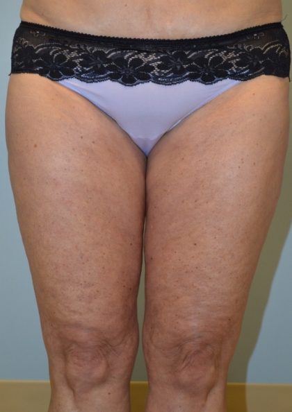 Fat Reduction (Non-Invasive) Before & After Patient #2939