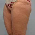 Fat Reduction (Non-Invasive) Before & After Patient #2939