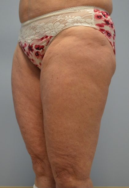 Fat Reduction (Non-Invasive) Before & After Patient #2939