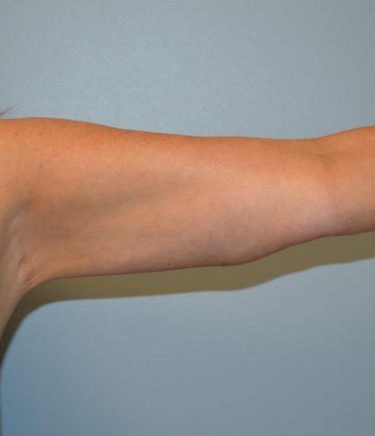 Arm Lift (Scarless Arm Lift) Before & After Patient #2874