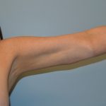 Arm Lift (Scarless Arm Lift) Before & After Patient #2874