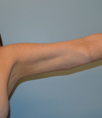 Arm Lift (Scarless Arm Lift) Before & After Patient #2874