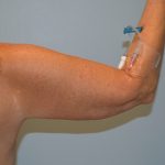 Arm Lift (Scarless Arm Lift) Before & After Patient #2874