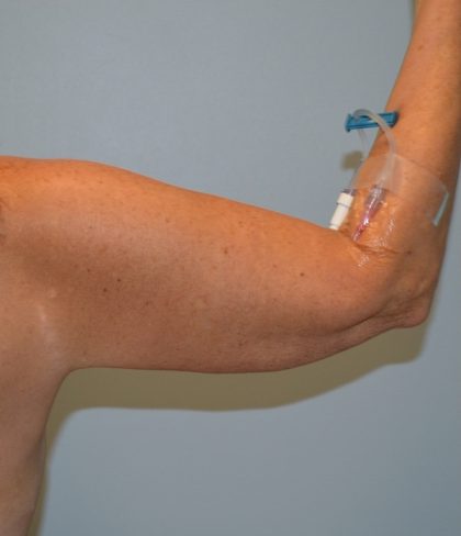 Arm Lift (Scarless Arm Lift) Before & After Patient #2874