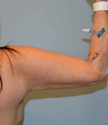 Arm Lift (Scarless Arm Lift) Before & After Patient #2874