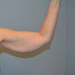 Arm Lift (Scarless Arm Lift) Before & After Patient #2879