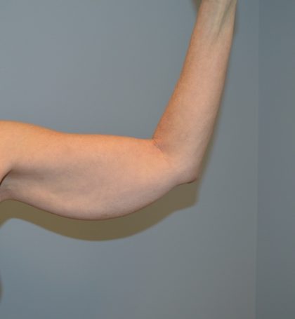 Arm Lift (Scarless Arm Lift) Before & After Patient #2879