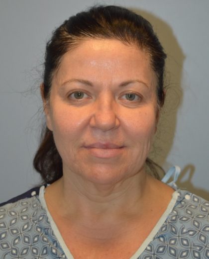 Facelift Before & After Patient #2937