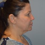 Facelift Before & After Patient #2937