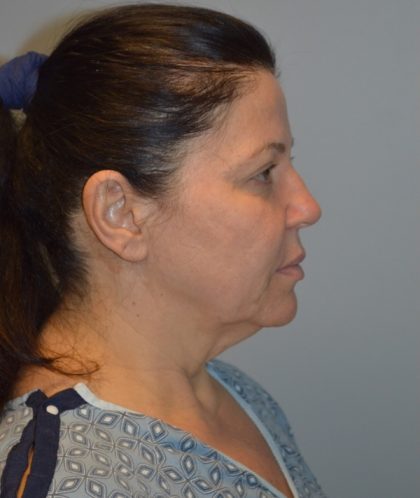 Facelift Before & After Patient #2937