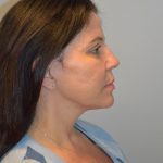 Facelift Before & After Patient #2937