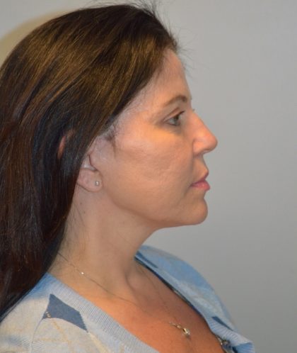 Facelift Before & After Patient #2937