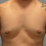 Male Breast (Gynecomastia) Before & After Patient #2961