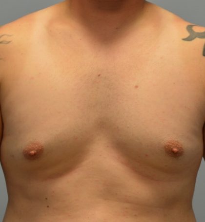 Male Breast (Gynecomastia) Before & After Patient #2961