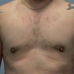 Male Breast (Gynecomastia) Before & After Patient #2961