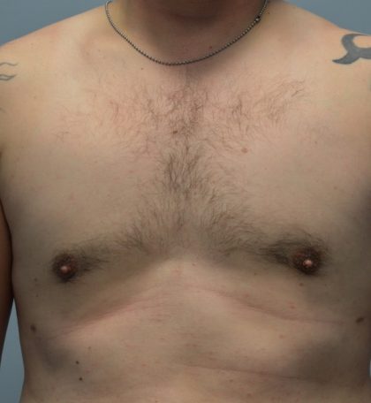 Male Breast (Gynecomastia) Before & After Patient #2961