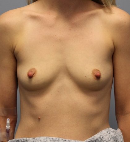 Breast Augmentation Before & After Patient #2913