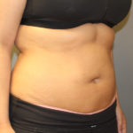 Fat Reduction (Non-Invasive) Before & After Patient #3175