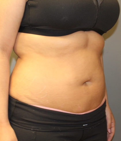 Fat Reduction (Non-Invasive) Before & After Patient #3175