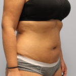 Fat Reduction (Non-Invasive) Before & After Patient #3175