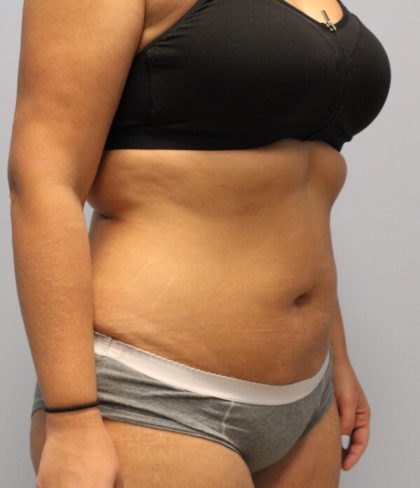 Fat Reduction (Non-Invasive) Before & After Patient #3175