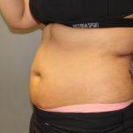 Fat Reduction (Non-Invasive) Before & After Patient #3175