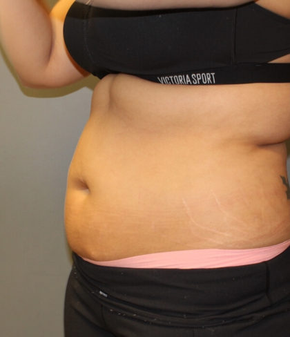 Fat Reduction (Non-Invasive) Before & After Patient #3175