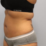 Fat Reduction (Non-Invasive) Before & After Patient #3175