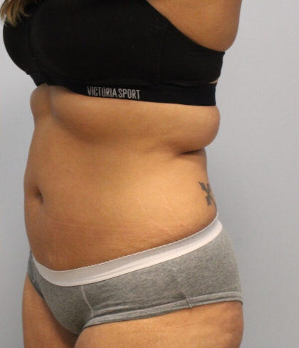 Fat Reduction (Non-Invasive) Before & After Patient #3175