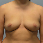 Breast Augmentation Before & After Patient #3225