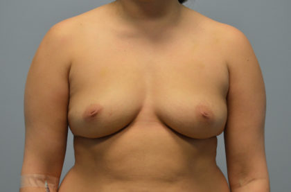 Breast Augmentation Before & After Patient #3225